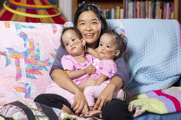 Австралиски хирурзи успешно раздвоија сијамски близначки