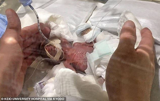 Јапонското бебе родено со 268 грама за 6 месеци накачи до 3,2 килограми