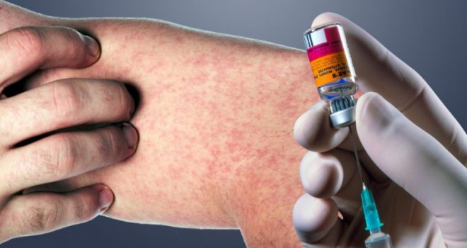 Во Хрватска почеток на епидемија на мали сипаници, досега 35 заболени