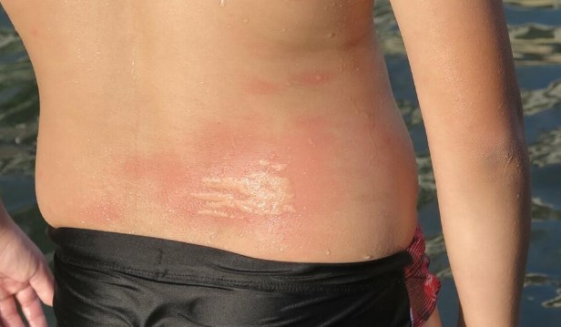 Остава трајни последици на кожата: Вака изгледа убод од медуза (ФОТО)